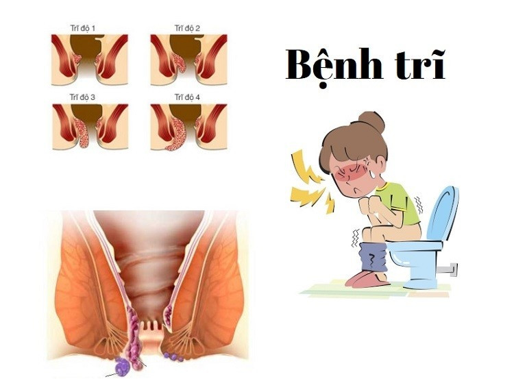 Nếu bạn thấy xuất hiện một vùng da thừa hoặc một búi nhỏ như thịt thừa xuất hiện tại hậu môn thì chắc chắn bạn đã bị bệnh trĩ. Ảnh: khoelahanhphuc.