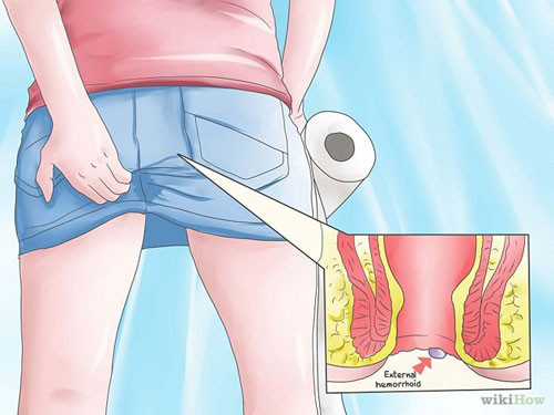 Ngoài việc đại tiện khó khăn thì người bệnh luôn có cảm giác nóng rát, khó chịu vùng hậu môn, kèm theo đó là cảm giác ẩm ướt vùng hậu môn. Ảnh: googleusercontent.