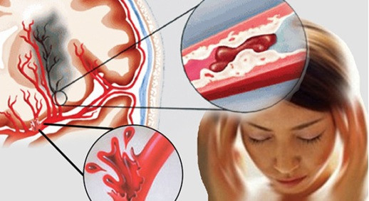 Những người mắc các bệnh về tim sẽ có nguy cơ cao bị tai biến mạch máu não. Ảnh: vtv1.