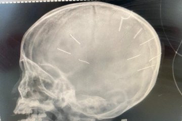 Cong an lay loi khai me be gai nghi ghim 9 dinh vao dau con