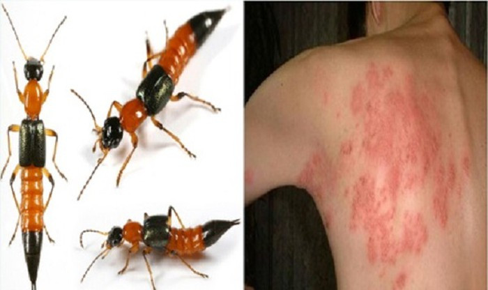 Kiến ba khoang tên khoa học là Paederus fuscipes. Trong cơ thể của loài côn trùng này cũng chứa chất cực độc Pederin, độc tính gấp 12-15 lần nọc rắn hổ. May mắn là tuy độc tính cực cao, nhưng với lượng nhỏ và tiếp xúc ngoài da nên không đủ để gây nguy hiểm đến tính mạng. Tuy nhiên, nọc độc của kiến ba khoang gây đau, ngứa, sưng tấy, sốt…