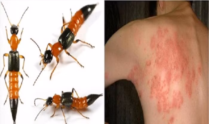 Kiến ba khoang tên khoa học là Paederus fuscipes. Trong cơ thể của loài côn trùng này cũng chứa chất cực độc Pederin, độc tính gấp 12-15 lần nọc rắn hổ. May mắn là tuy độc tính cực cao, nhưng với lượng nhỏ và tiếp xúc ngoài da nên không đủ để gây nguy hiểm đến tính mạng. Tuy nhiên, nọc độc của kiến ba khoang gây đau, ngứa, sưng tấy, sốt…