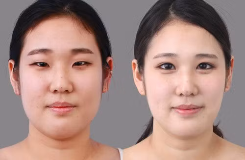 Tạo mắt hai mí. Người phương Tây rất ấn tượng với đôi mắt một mí của các cô gái châu Á và ví nó là mắt hình hạnh nhân.