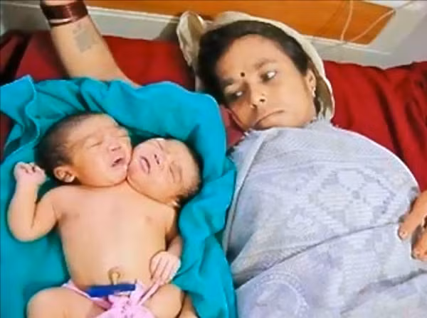 Thực tế, các chuyên gia cho rằng đây là trường hợp chị em song sinh dính liền có chung cơ thể, 2 cánh tay và 3 chân. Được biết, 2 em bé này mắc phải tình trạng gọi là dicephalic parapagus - dị tật hiếm gặp chỉ ảnh hưởng đến 1 trong 50.000 đến 100.000 ca sinh nở.