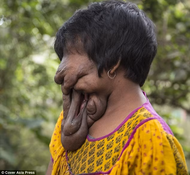 Khadija Khatoon, 21 tuổi, sinh ra trong một gia đình nghèo ở Kolkata, miền Đông Ấn Độ. Ai nhìn cô cũng không thể phân biệt mắt với mũi. Khuôn mặt cô chỉ có một khe hở nhỏ phía bên trái.