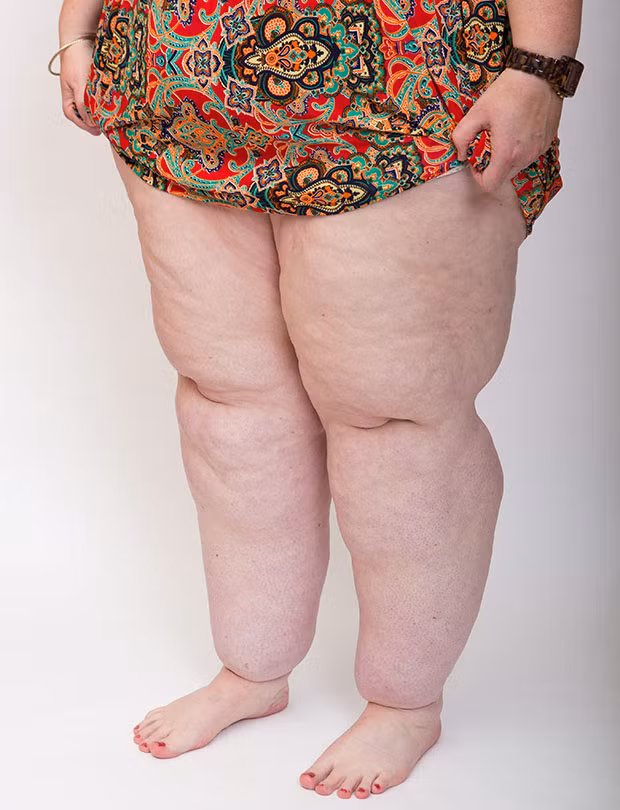 Các chuyên gia cũng cảnh báo, nếu đôi chân cứ tiếp tục phát triển, cô Claire có thể sẽ phải ngồi xe lăn do viêm xương khớp nghiêm trọng. Hiện giờ, Claire mong muốn sẽ sớm được hút mỡ, giúp cô có thể chữa trị được căn bệnh này.