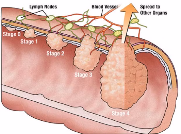 Người có polyp trực tràng - đây là khu vực lồi lên ở nội mach ruột già và ruột thẳng. Nếu những ai bị polyp đại tràng mà không chữa trị kịp thời, để lâu ngày thì các polyp đó có nguy cơ rất cao phát triển thành ung thư trực tràng.