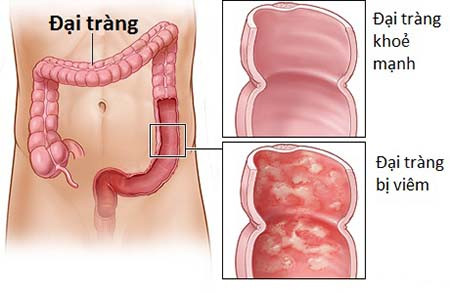 Người bị viêm loét đại trực tràng và bệnh Crohn. Đây là những bệnh gây viêm mạn tính lớp niêm mạc của đại trực tràng, lâu ngày có thể hóa ung thư như nhạc sĩ Trần Lập.
