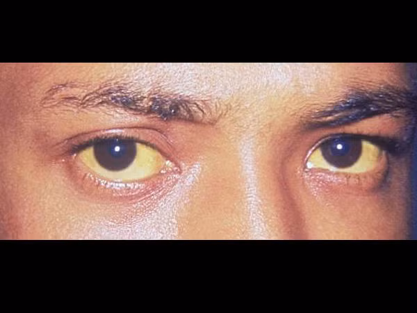 Nếu bạn nhận thấy đôi mắt hoặc da chuyển màu vàng, đây có thể là dấu hiệu đáng báo động vì đây là tác dụng phụ nghiêm trọng của thuốc tránh thai. Hãy tham khảo ý kiến bác sĩ ngay lập tức về trường hợp này.