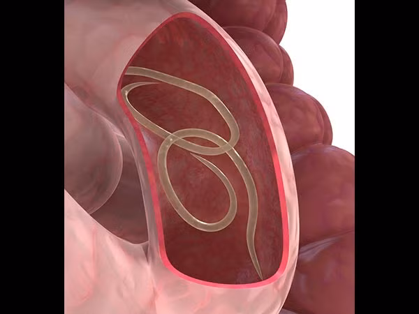 Làm sao giun "chui" vào trong cơ thể người được? Các chuyên gia cho hay, khi con người tiếp xúc với phân của người bị nhiễm giun sán, người đó có thể dễ dàng bị lây nhiễm. Phân chứa trứng giun có thể có mặt ở thực phẩm, nước, đất. Khi tiêu thụ thực phẩm kém vệ sinh, sống ở khu vực vệ sinh kém chính là điều kiện trứng giun đi vào cơ thể người và sinh sôi, nảy nở trong đường ruột.
