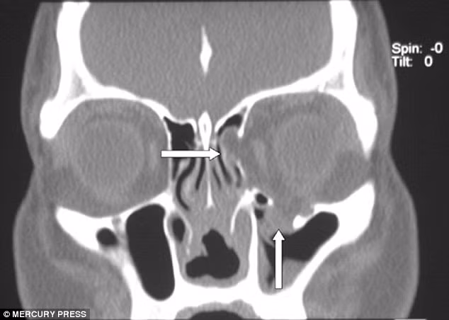 Cô cũng là người đầu tiên được tái tạo lại khuôn mặt bằng cách sử dụng vật liệu sinh học hoạt tính gọi là Bioactive Glass.