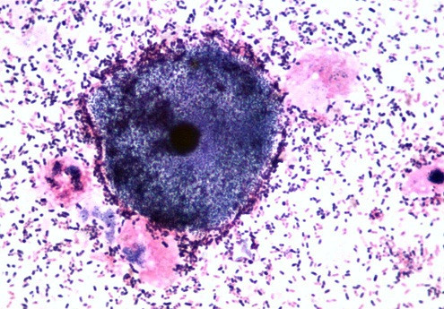 Nguyên nhân là do sự thay đổi nồng độ Hormon Estrogen trong cơ thể dẫn đến tiết ra nhiều khí hư hơn bình thường, làm thay đổi môi trường âm đạo, hấp dẫn sự phát triển của các vi khuẩn gây nhiễm trùng nấm men và viêm. Ngoài ra, hệ miễn dịch của phụ nữ trong thai kì kém, việc bụng to khiến các chị em vệ sinh vùng kín khó khăn hơn hoặc do tác dụng phụ của một số loại thuốc an thai.