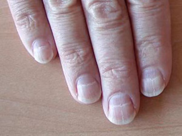 Móng tay xuất hiện đường viền trắng ngang. Nếu xuất hiện các đường màu trắng chạy ngang qua móng tay có thể là một dấu hiệu của bệnh suy dinh dưỡng, lượng protein thấp hoặc gan có vấn đề.