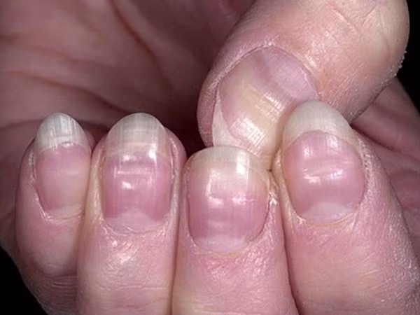 Móng tay đột nhiên có rãnh. Rãnh hoặc các nếp nhăn là dấu hiệu ở móng tay cảnh báo thiếu máu lưu thông đến các đầu ngón tay. Thiếu hụt kẽm, vi khuẩn gây nhiễm trùng, nhiệt độ lạnh và hóa trị cũng là những nguyên nhân gây ra triệu chứng này.