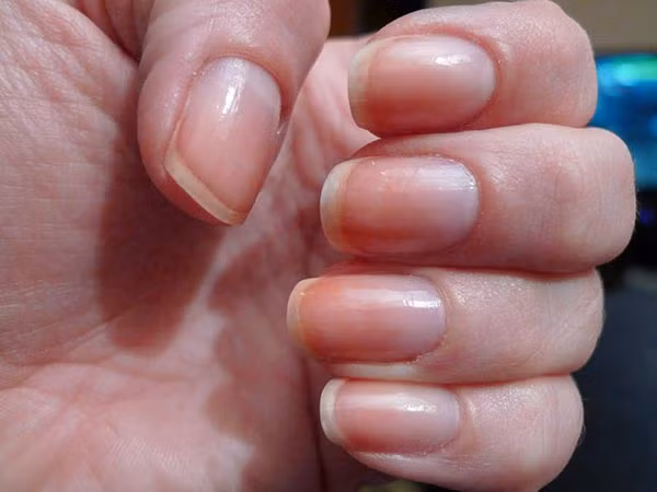 Móng tay chuyển sang màu vàng hoặc trắng. Sử dụng sơn móng tay trong thời gian dài có thể khiến móng tay trở nên trắng nhợt hoặc chuyển màu vàng. Ngoài ra, móng tay màu vàng cũng là dấu hiệu của bệnh gan và vàng da. Nhiễm trùng đường hô hấp cũng khiến cho móng tay chuyển màu nhợt nhạt.