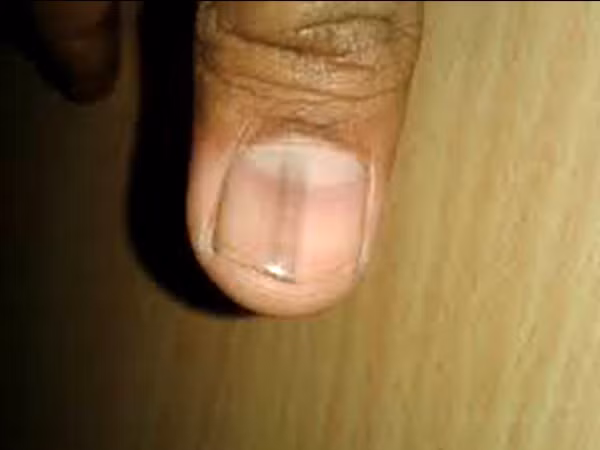 Móng tay có sọc đen cảnh báo ung thư. Móng tay xuất hiện những sọc đen là dấu hiệu cảnh báo bệnh ung thư da, được gọi là khối u ác tính subungual. Hiện tượng này thường chỉ xuất hiện ở một móng duy nhất trên bàn tay.