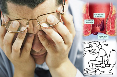 Bệnh trĩ, việc ngồi lâu trên bồn cầu sẽ gây ứ máu trong khoang chậu và khúc cong của tĩnh mạch trĩ, dần dần dẫn đến bệnh trĩ. Đồng thời gây chèn ép vào thần kinh và mạch máu mặt sau đùi, dẫn đến tê cả chi dưới, thiếu máu chi dưới và hồi lưu máu tĩnh mạch kém đi.