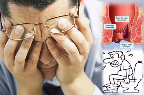 Bệnh trĩ, việc ngồi lâu trên bồn cầu sẽ gây ứ máu trong khoang chậu và khúc cong của tĩnh mạch trĩ, dần dần dẫn đến bệnh trĩ. Đồng thời gây chèn ép vào thần kinh và mạch máu mặt sau đùi, dẫn đến tê cả chi dưới, thiếu máu chi dưới và hồi lưu máu tĩnh mạch kém đi.