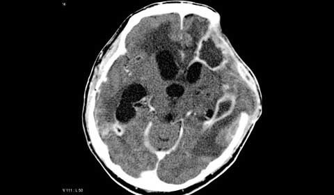 Áp-xe não. Là những ổ nhiểm khuẩn khu trú trong nhu mô não gây mủ. Thường áp-xe não gây viêm màng não mủ. Áp-xe não gây tỷ lệ tử vong rất cao và biến chứng nặng nề. Chẩn đoán như lâm sàng tràn dịch dưới màng cứng nhờ siêu âm và scanner. Điều trị bằng cách dẫn lưu mủ, bóc tách và kháng sinh.