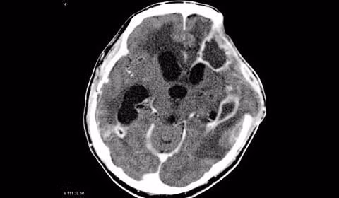 Áp-xe não. Là những ổ nhiểm khuẩn khu trú trong nhu mô não gây mủ. Thường áp-xe não gây viêm màng não mủ. Áp-xe não gây tỷ lệ tử vong rất cao và biến chứng nặng nề. Chẩn đoán như lâm sàng tràn dịch dưới màng cứng nhờ siêu âm và scanner. Điều trị bằng cách dẫn lưu mủ, bóc tách và kháng sinh.
