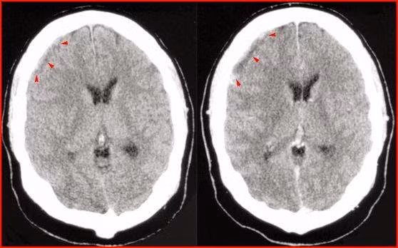 Tụ mủ dưới màng cứng. Gặp trong viêm màng não mủ thứ phát sau viêm tai giữa, sau viêm tai xương chũm. Lâm sàng như tràn dịch dưới màng cứng nhưng sốt cao dao động. Xử trí bằng dẫn lưu, kháng sinh.