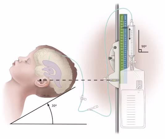 Viêm não thất. Thường gặp ở trẻ sơ sinh, bệnh khiến trẻ rối loạn ý thức, protein tăng cao, sốt hoặc không, dãn vòng đầu, dãn khớp sọ. Chẩn đoán dựa vào siêu âm và chọc dò não thất . Điều trị bằng chọc hút và kháng sinh tại chổ.