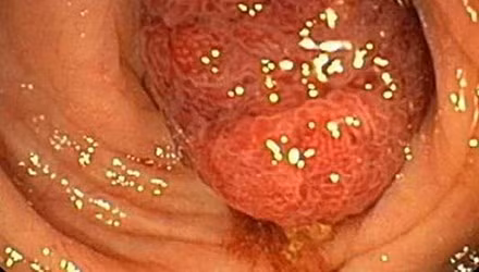 Tắc nghẽn do khối u: Khối u không ngừng phát triển, khi đã to gây nên hẹp đường ruột, dẫn đến sưng ruột, nhiễm trùng hoặc nhiễm độc máu.