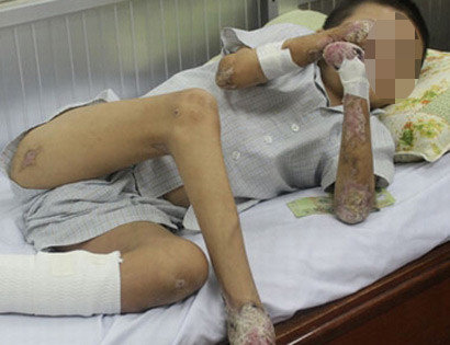 So hai can benh la quai ac khien tay chan rung dan-Hinh-2