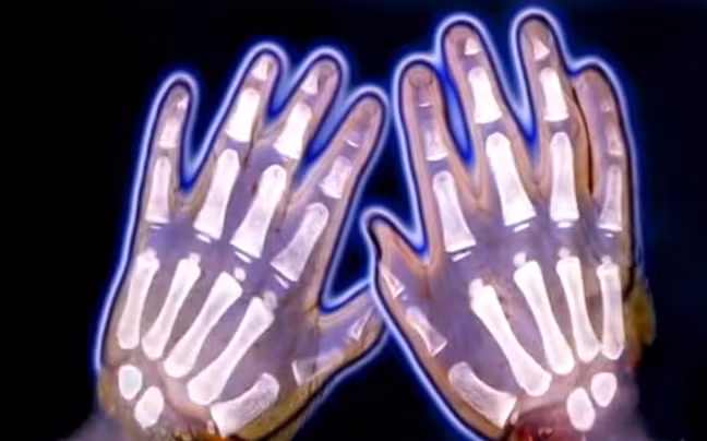 Kết quả chụp X quang đôi bàn tay cho thấy, bộ phận cơ thể này của một nam giới trên 60 tuổi. Móng của ngón tay cái bên phải đã biến mất. Cảnh sát tới từng nhà xác và bệnh viện trong thành phố để tìm tử thi mất đôi bàn tay, nhưng họ không thấy bất kỳ xác người nào như vậy.