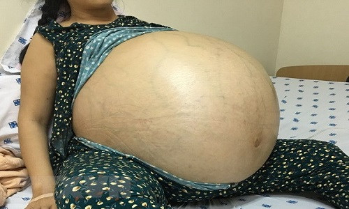 Bệnh nhân Đ.T.T với khối u khổng lồ trước phẫu thuật. (Ảnh:TTXVN/phát)