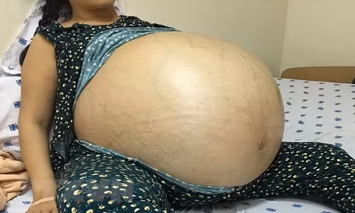 Bệnh nhân Đ.T.T với khối u khổng lồ trước phẫu thuật. (Ảnh:TTXVN/phát)