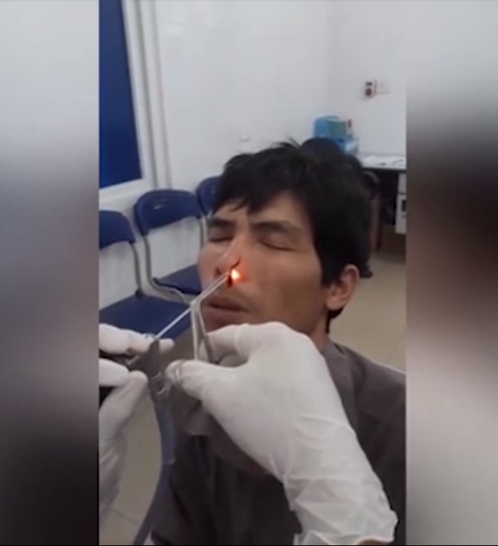 Người đàn ông này ở tỉnh Nghệ An đã tới bệnh viện để khám sau khi cảm thấy khó thở. Bác sĩ đã phát hiện một con đỉa sống trong lỗ mũi của bệnh nhân và sử dụng thiết bị laser để lấy con đỉa dài khoảng 2,5 cm ra khỏi mũi người đàn ông. Nguyên nhân của câu chuyện khó tin trên là do người đàn ông đã uống nước suối trong khi làm việc ở rừng gần Vườn quốc gia Pù Mát.