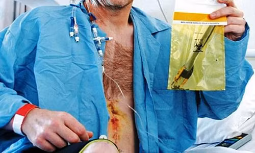 Các bác sĩ từng để quên một thiết bị kẹp dài 25,4 cm trong bụng bệnh nhân Daryoush Mazarei trong một ca phẫu thuật. Ảnh: Wonders List.