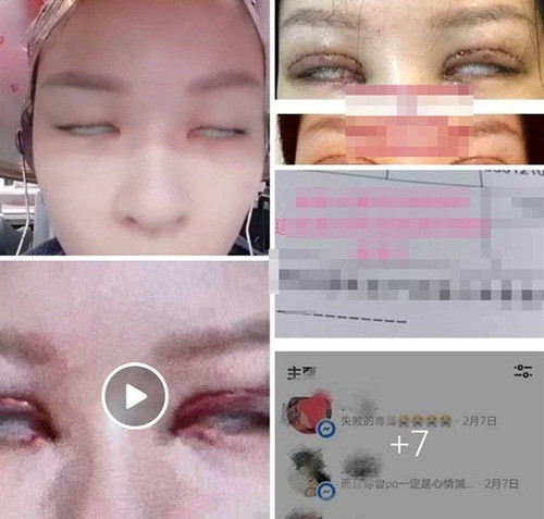 Kinh hoang bien chung sau cat mi, nguoi phu nu khong the nham mat-Hinh-2