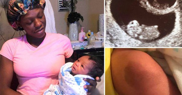 Vet bot tren nguoi be trai va su trung hop ky dieu voi em gai song sinh da mat