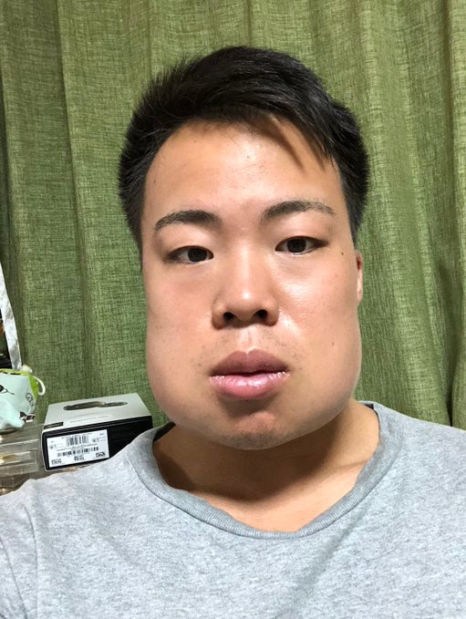 Nho cung luc 4 chiec rang khon, thanh nien mat sung nhu qua du du-Hinh-2