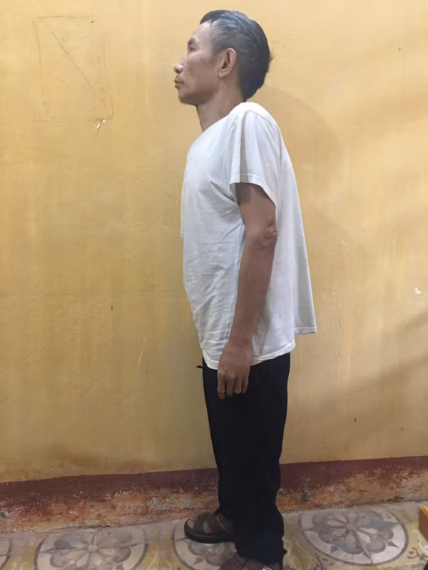 Ngày 7/9/1990, Thành “gù” đi ăn sáng tại khu vực Chợ Con. “Chả hiểu sao hôm đó giời xui đất khiến thế nào mà khi vào quán tôi lại cứ nhìn trân trân vào mặt anh ta. Thấy vậy, anh ta bảo: “mày thích nhìn đểu tao à. Sau khi lời qua tiếng lại, anh ta đấm một phát vào mặt khiến tôi choáng váng”, Thành “gù” nhớ lại. Sau khi bị một cú đấm trời giáng, Thành “gù” rút dao đâm thẳng vào đối phương khiến nạn nhân Phạm Văn Bình, sinh 1959 tử vong. Sau nhát đâm đó, Thành “gù” vùng bỏ chạy và kết quả là ông ta đã chạy một mạch suốt 33 năm. (Ảnh: CAND) 