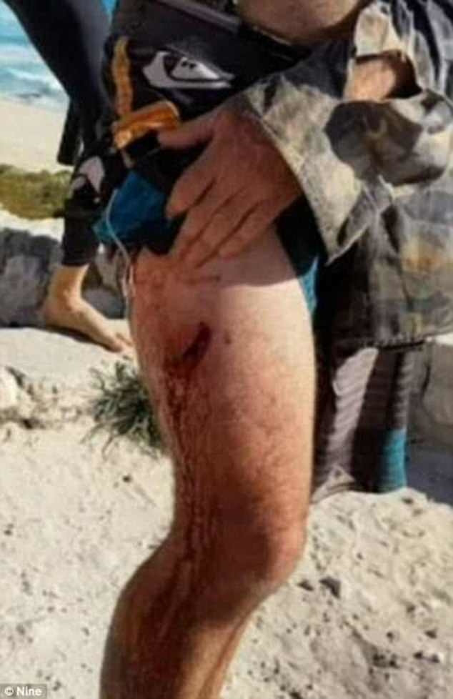 Vết thương do cá mập trắng gây ra.