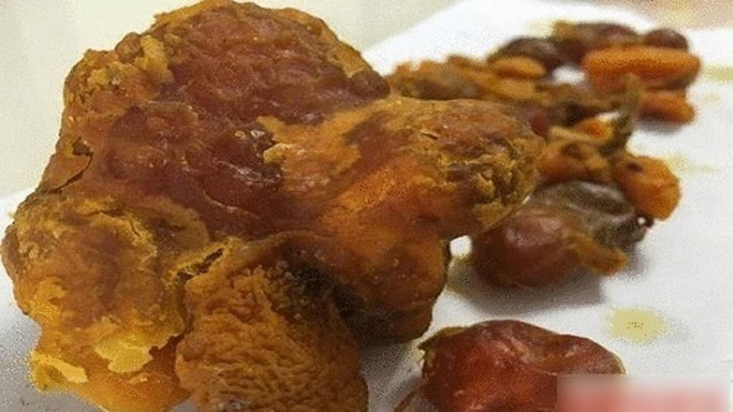 Người đàn ông liên hệ với các công ty bán đấu giá "kê bảo" ở Thượng Hải và Thâm Quyến. Họ đề nghị mua lại vật thể này với mức giá hàng triệu nhân dân tệ (tương đương hàng chục tỷ đồng). Tuy nhiên, người đàn ông và gia đình chưa quyết định bán.