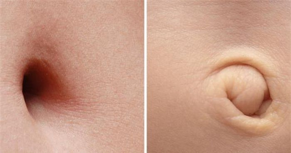 5. Rốn của mỗi người là độc nhất vô nhị. Rốn của mỗi người hoàn toàn khác nhau không chỉ bởi sự khác biệt về hình dạng bên ngoài mà còn là những thứ được chứa đựng bên trong. Đó chính là vi khuẩn. Có khoảng 2.400 loài vi khuẩn khác nhau đã được tìm thấy trong rốn con người. Và trong rốn mỗi người có chứa đựng vi khuẩn không hề giống nhau. Người ta đã từng tìm thấy loài vi khuẩn “độc quyền” tại các mẫu đất của Nhật Bản trong rốn của một người đàn ông. Điều đặc biệt là người đó chưa đến Nhật Bản bao giờ.