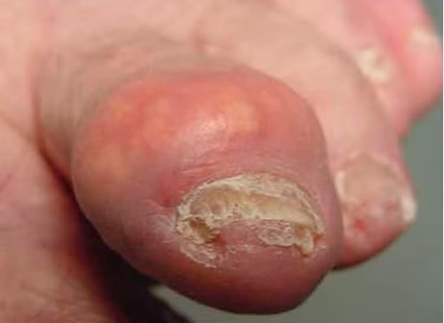 Bệnh càng biểu hiện nặng hơn khi uống rượu nhiều và ăn quá nhiều chất béo. Ảnh minh họa.