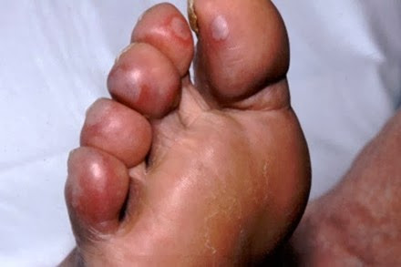 Khi bị cước chân tay, người bệnh cảm thấy đau đớn vùng bị tổn thương, thâm tím khi nhúng vào nước lạnh. Ảnh minh họa.