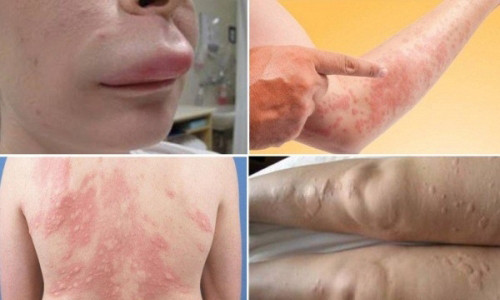 Khi bị mề đay, người bệnh tự nhiên thấy ngứa từng đám rất khó chịu, gãi nhiều. Ảnh minh họa.