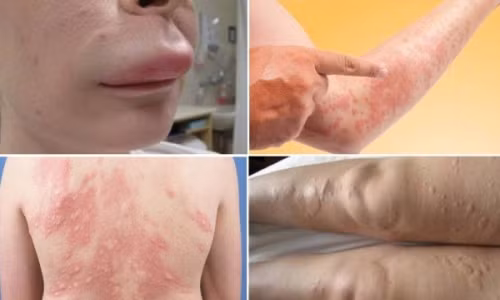 Khi bị mề đay, người bệnh tự nhiên thấy ngứa từng đám rất khó chịu, gãi nhiều. Ảnh minh họa.