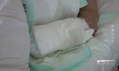 Cô đã mất đi bàn tay trái vĩnh viễn.