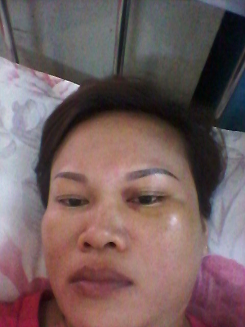 Chị Chiêm với nhiều thương tích mà chị nói là do bị chồng đánh.