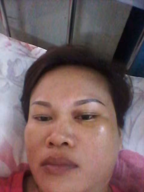 Chị Chiêm với nhiều thương tích mà chị nói là do bị chồng đánh.