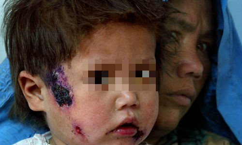 IS gian tiep gay ra dich benh chet nguoi Leishmania o Syria