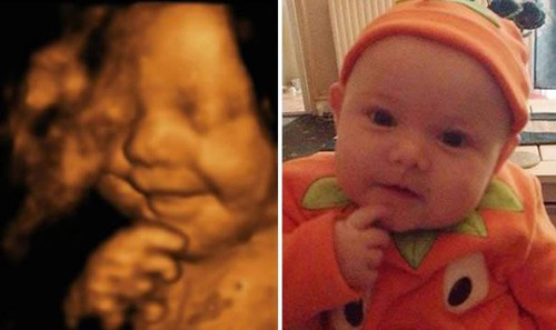 6. Ảnh siêu âm em bé cười trong bụng mẹ Cặp bố mẹ trẻ Amy Cregg và Leighton Hargreaves từ Accrington, Lancs nước Anh cảm thấy vô cùng tự hào và hạnh phúc khi hình ảnh chụp siêu âm cậu con trai Leo 31 tuần tuổi như nở nụ cười khi còn đang trong bụng mẹ. Hiện tại, bố mẹ bé cho biết kể từ sau khi sinh đến nay đã 4 tháng tuổi, Leo thường xuyên nở nụ cười với mọi người, ngay cả trong lúc ngủ. Một công ty người mẫu nhí đã liên lạc với cha mẹ của Leo với mong muốn mua lại bức hình siêu âm nụ cười của cậu bé vì cảm thấy khá thú vị.