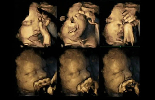 7. Ảnh siêu âm thai nhi nhăn mặt khi mẹ hút thuốc Hành động khó hiểu của thai nhi cùng biểu hiện nhăn nhó khi mẹ bé hút thuốc đã được ghi lại qua hình ảnh siêu âm 4D, đồng thời cho thấy tác hại xấu của việc hút thuốc đến quá trình mang thai. Tiến sĩ Nadja Reissland nghiên cứu những hình ảnh siêu âm 4D của hàng nghìn hành động rất nhỏ của thai nhi, đặc biệt ở những bà mẹ hút thuốc lá. Trong khi những bà mẹ không hút thuốc thường thai nhi không có những biểu hiện như trên.